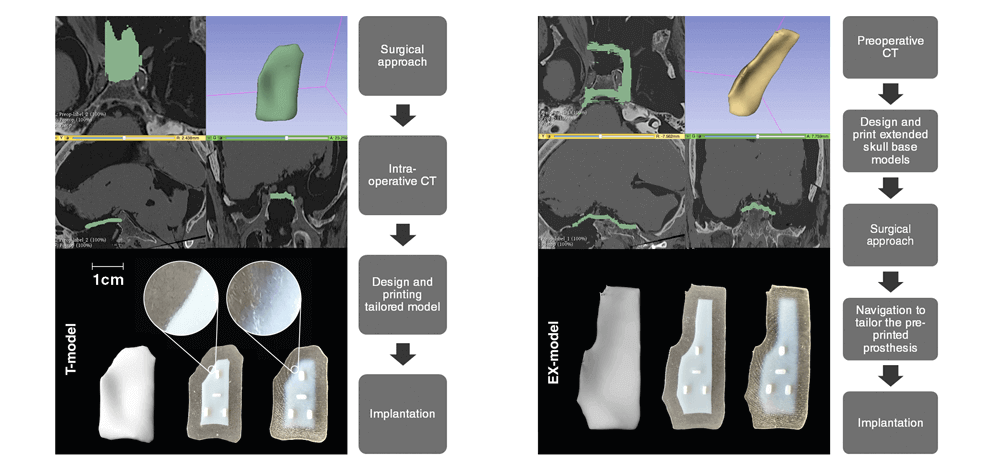 3d-printing-intraoperative-neuronavigation-tailoring-skull-base-reconstruction-after-extended-endoscopic-endonasal-surgery-2